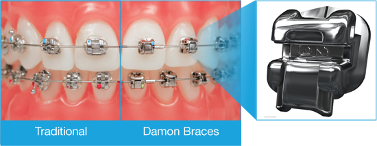 Compare between Traditional and Damon Braces