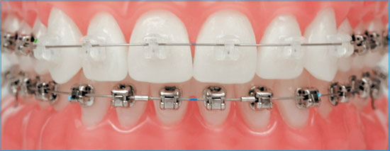 Choose Typodont Teeth