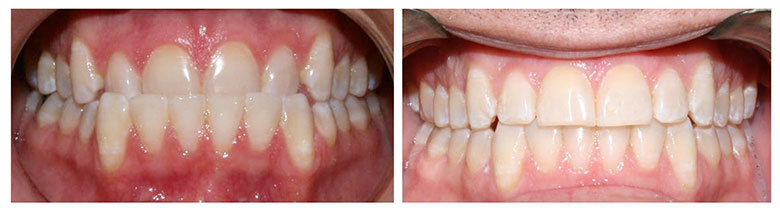 Invisalign Results