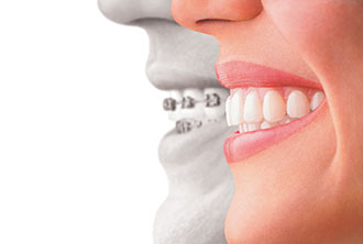 Invisalign Orthodontic Appliance Packaging